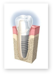 services_dental_implants